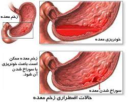 بررسی کامل زخم معده و پیشگیری از آن